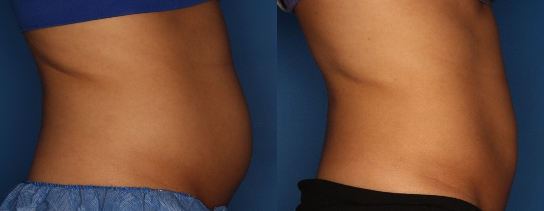 CoolSculpting Gallery Before & After Gallery - Patient 111945944 - Image 3