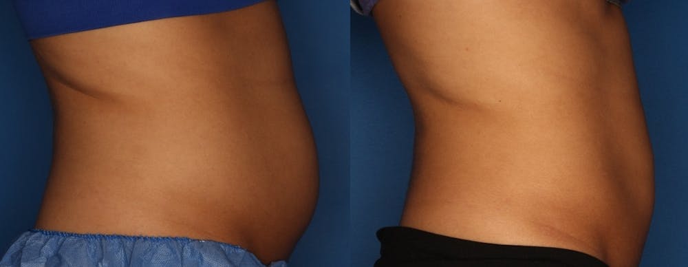 CoolSculpting Gallery - Patient 111945944 - Image 3