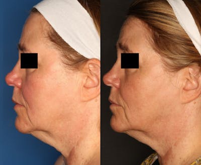 Excel V. Gallery Before & After Gallery - Patient 57949726 - Image 2