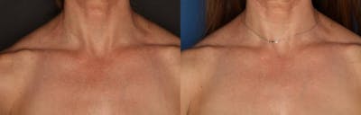 IPL Photorejuvenation Gallery Before & After Gallery - Patient 109915582 - Image 1