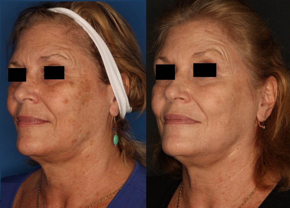 LaserFirm Gallery Before & After Gallery - Patient 65828167 - Image 1