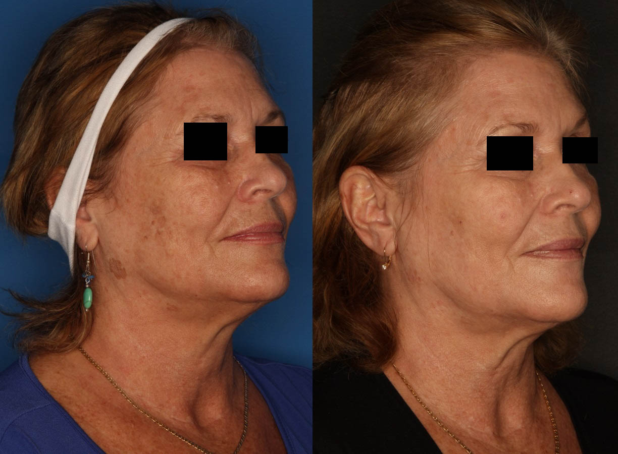 LaserFirm Before & After Gallery - Patient 65828167 - Image 2