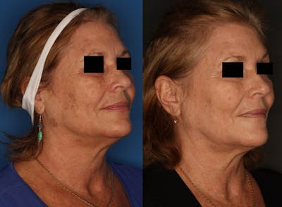 LaserFirm Gallery Before & After Gallery - Patient 65828167 - Image 2