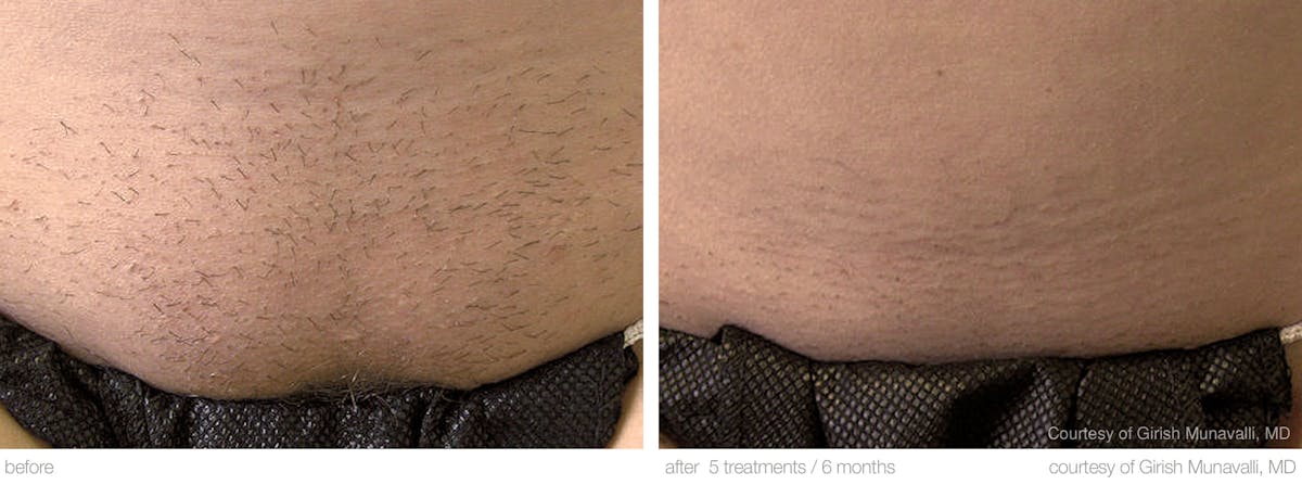 Laser Hair Removal Before & After Gallery - Patient 36623102 - Image 1
