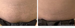 Before and After of Laser Hair Removal in San Diego