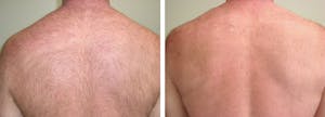 Before and After of Laser Hair Removal in La Jolla