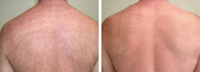 Laser Hair Removal Before & After Gallery - Patient 36623101 - Image 1