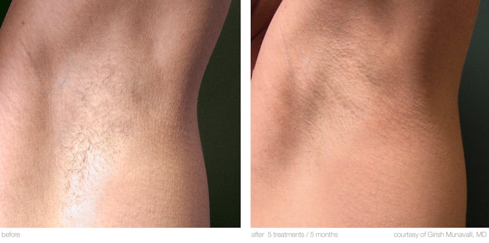Laser Hair Removal Before & After Gallery - Patient 36623100 - Image 1