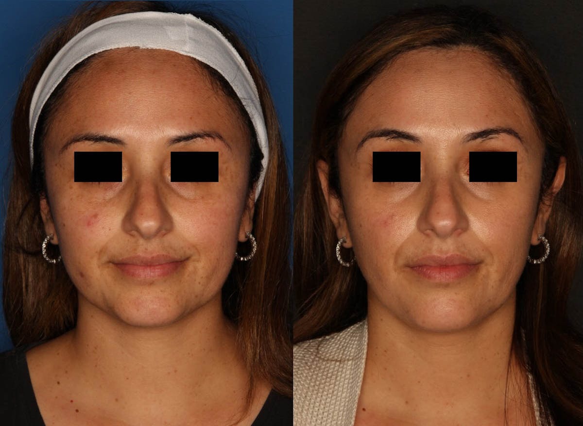 PiQo4™ Laser Before & After Gallery - Patient 65828439 - Image 1