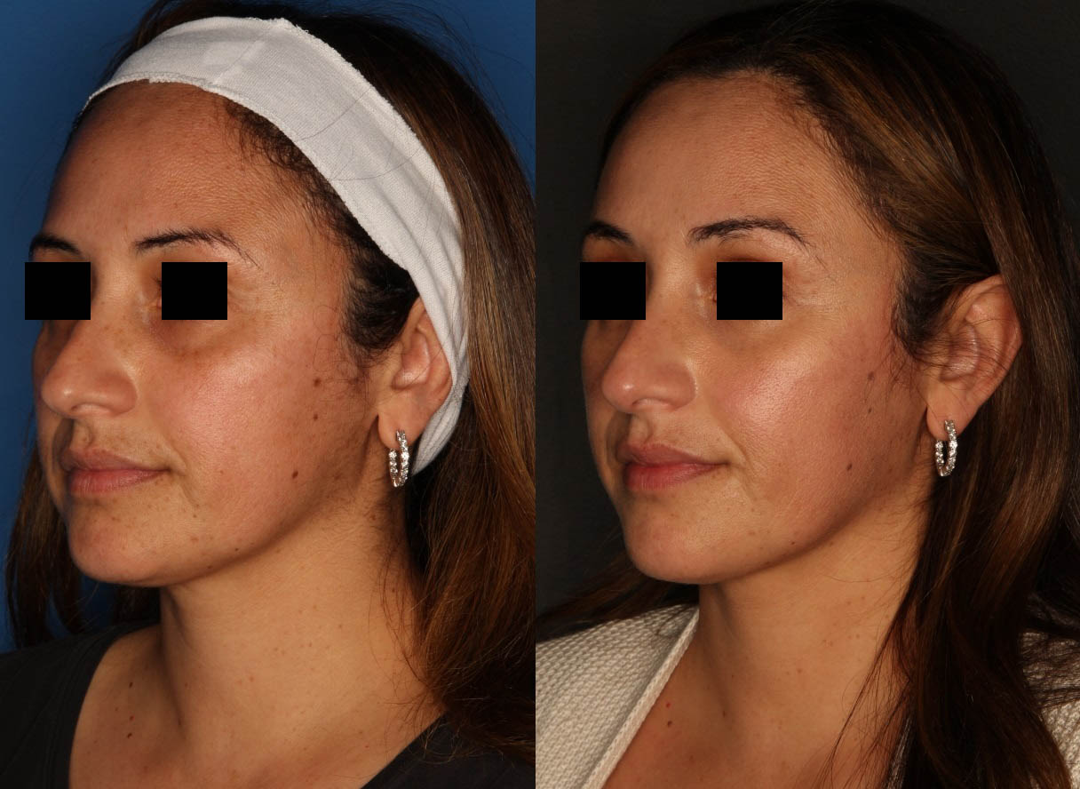 PiQo4™ Laser Before & After Gallery - Patient 65828439 - Image 2