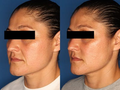 Juvederm Ultra XC Before & After Gallery - Patient 111639291 - Image 1