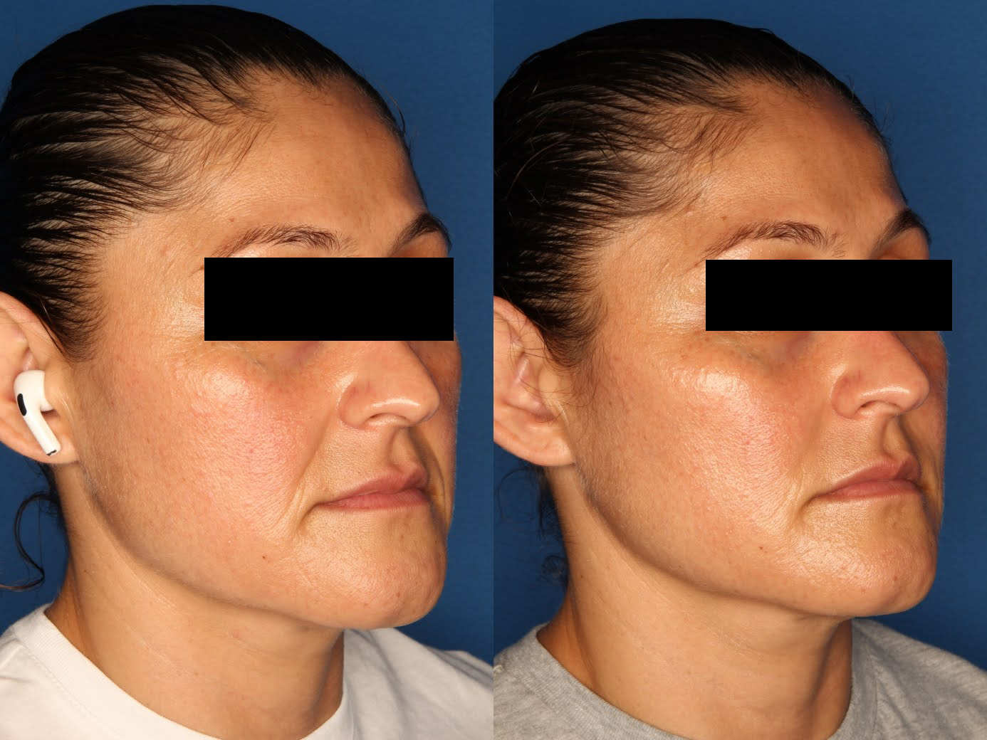 Juvederm Ultra XC Before & After Gallery - Patient 111639291 - Image 2