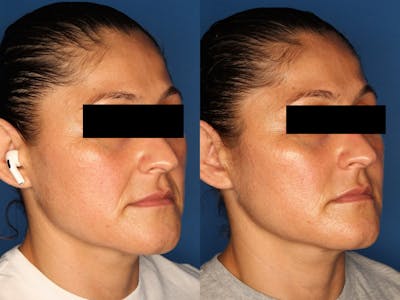 Dermal Fillers Gallery Before & After Gallery - Patient 272575 - Image 2