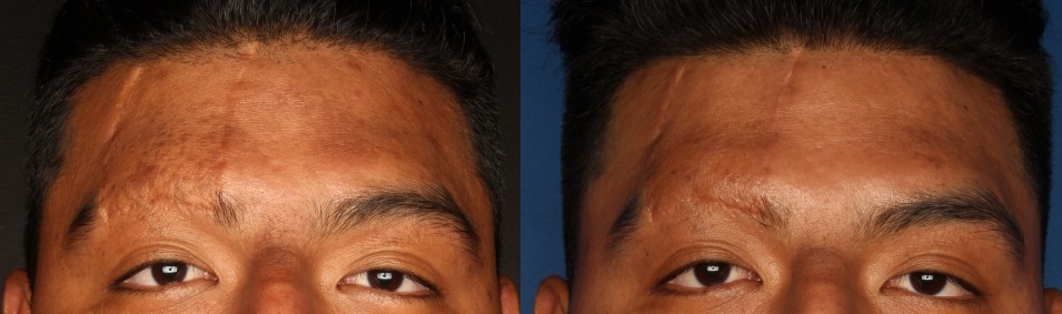 Microneedling Before & After Gallery - Patient 121121299 - Image 1