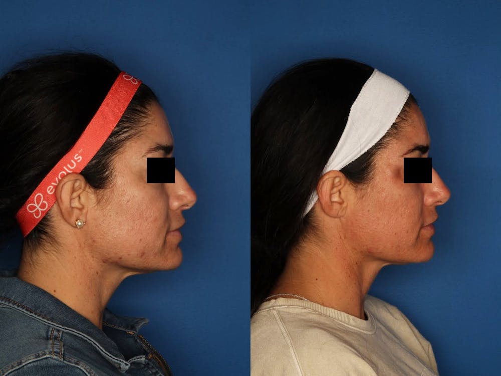 Morpheus8 Before & After Gallery - Patient 120731507 - Image 5