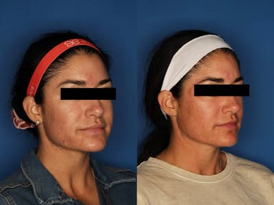 Morpheus8 Before & After Gallery - Patient 120731507 - Image 4
