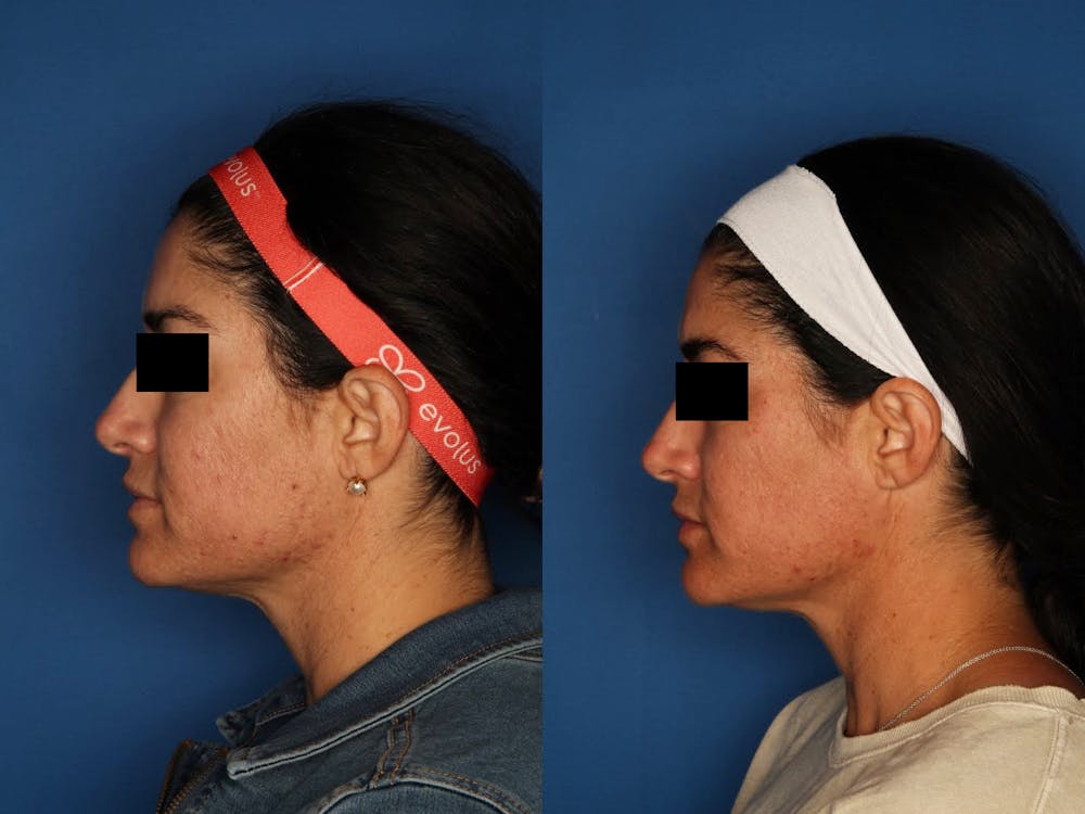 Morpheus8 Before & After Gallery - Patient 120731507 - Image 3