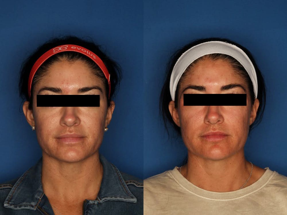 Morpheus8 Before & After Gallery - Patient 120731507 - Image 1