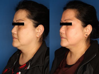 Cosmelan Peel Gallery Before & After Gallery - Patient 120374586 - Image 2