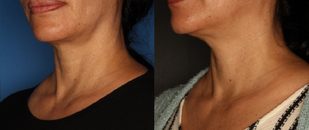 Sculptra Aesthetic Before & After Gallery - Patient 59448293 - Image 1