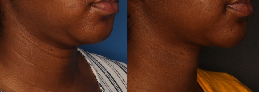 Kybella Before & After Gallery - Patient 56675629 - Image 1
