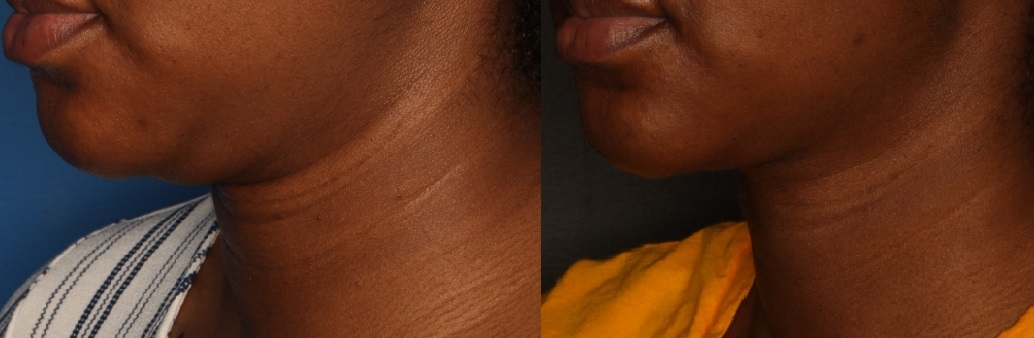 Kybella Gallery Before & After Gallery - Patient 56675629 - Image 3
