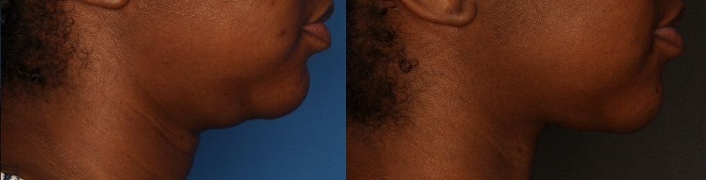 Kybella Gallery Before & After Gallery - Patient 56675629 - Image 2