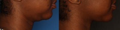 Kybella Gallery Before & After Gallery - Patient 56675629 - Image 2