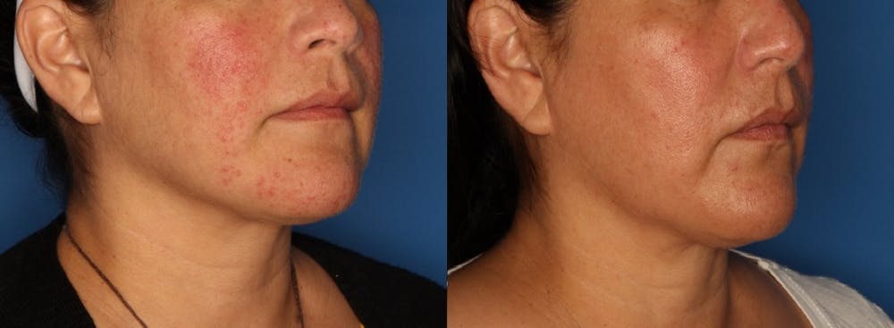AQUAGOLD® Facial Rejuvenation  Before & After Gallery - Patient 122372413 - Image 1