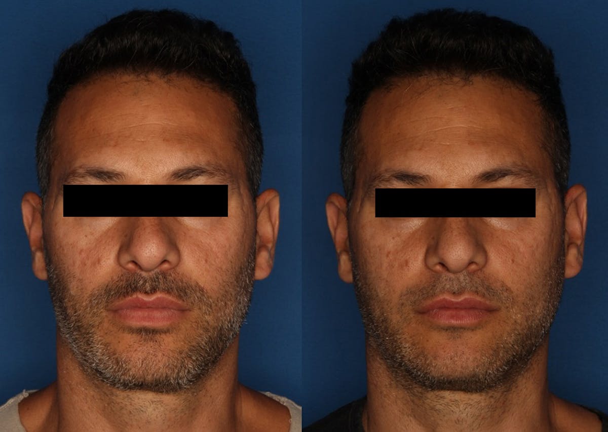 PRP Hair Loss Before & After Gallery - Patient 122683150 - Image 1