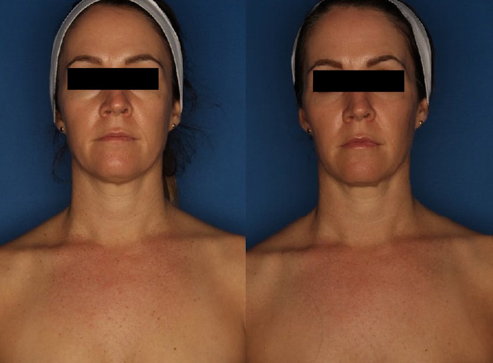 LaserFirm Before & After Gallery - Patient 123862184 - Image 1