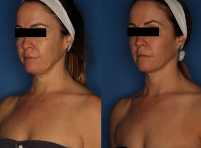 LaserFirm Gallery Before & After Gallery - Patient 123862184 - Image 2