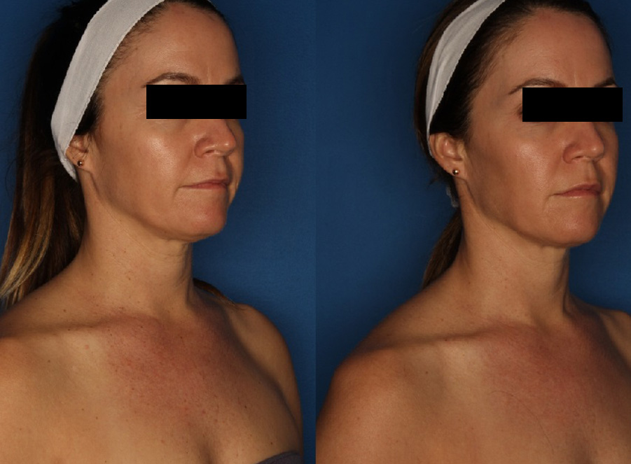 LaserFirm Gallery Before & After Gallery - Patient 123862184 - Image 3