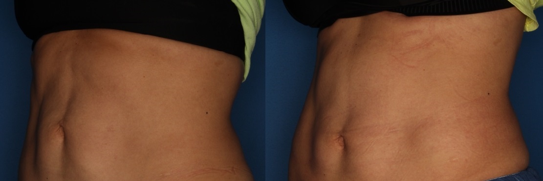 TruSculpting Before & After Gallery - Patient 140401010 - Image 2