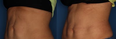 TruFlex Before & After Gallery - Patient 140401010 - Image 2