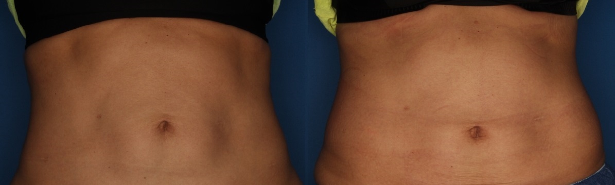 TruFlex Before & After Gallery - Patient 140401010 - Image 3