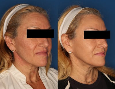 HALO® Laser by Sciton Gallery Before & After Gallery - Patient 141160496 - Image 2