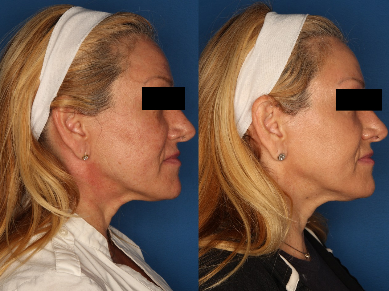 HALO® Laser by Sciton Gallery Before & After Gallery - Patient 141160496 - Image 3