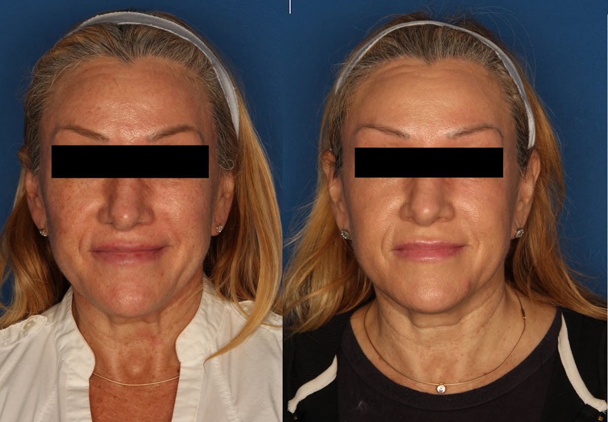 HALO® Laser by Sciton Gallery Before & After Gallery - Patient 141160496 - Image 1