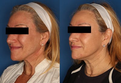 HALO® Laser by Sciton Gallery Before & After Gallery - Patient 141160496 - Image 4