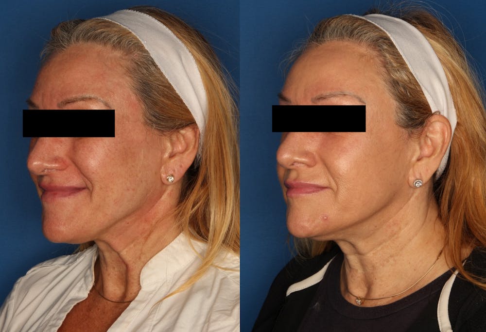 HALO® Laser by Sciton Before & After Gallery - Patient 141160496 - Image 4