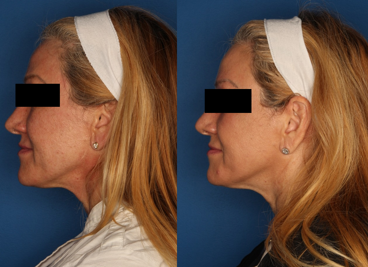 HALO® Laser by Sciton Gallery Before & After Gallery - Patient 141160496 - Image 5