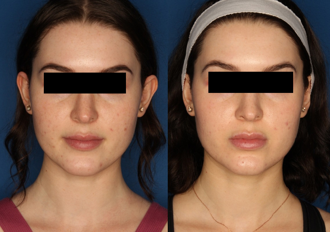 HALO® Laser by Sciton Before & After Gallery - Patient 142681538 - Image 1