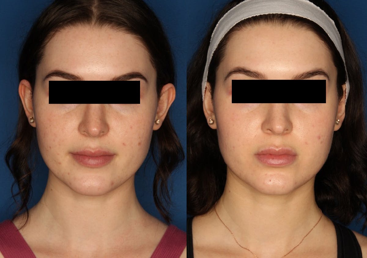 HALO® Laser by Sciton Before & After Gallery - Patient 142681538 - Image 1