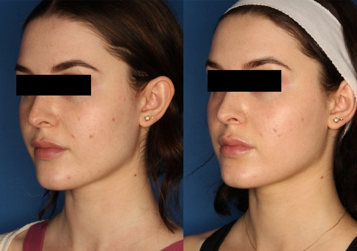 HALO® Laser by Sciton Before & After Gallery - Patient 142681538 - Image 2