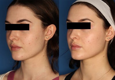 HALO® Laser by Sciton Gallery Before & After Gallery - Patient 142681538 - Image 2