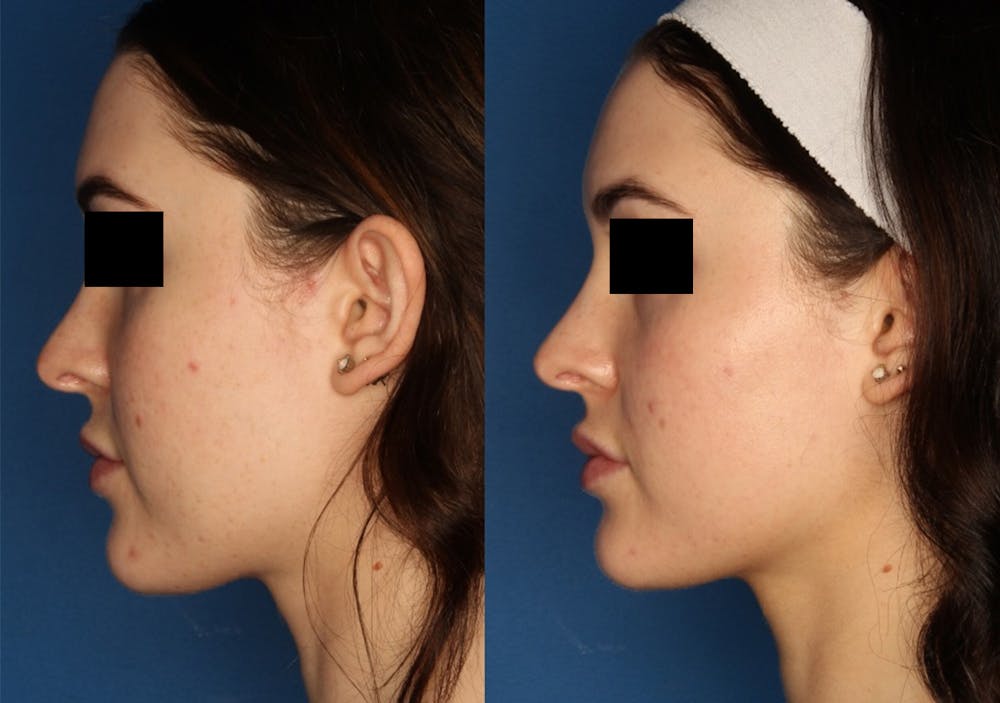 HALO® Laser by Sciton Before & After Gallery - Patient 142681538 - Image 3
