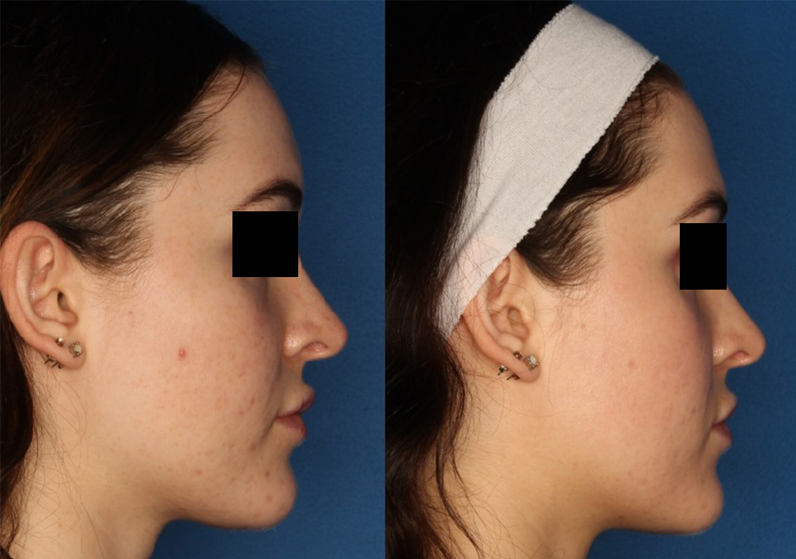 HALO® Laser by Sciton Gallery Before & After Gallery - Patient 142681538 - Image 5