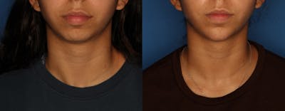 Dermal Fillers Gallery Before & After Gallery - Patient 212600 - Image 1