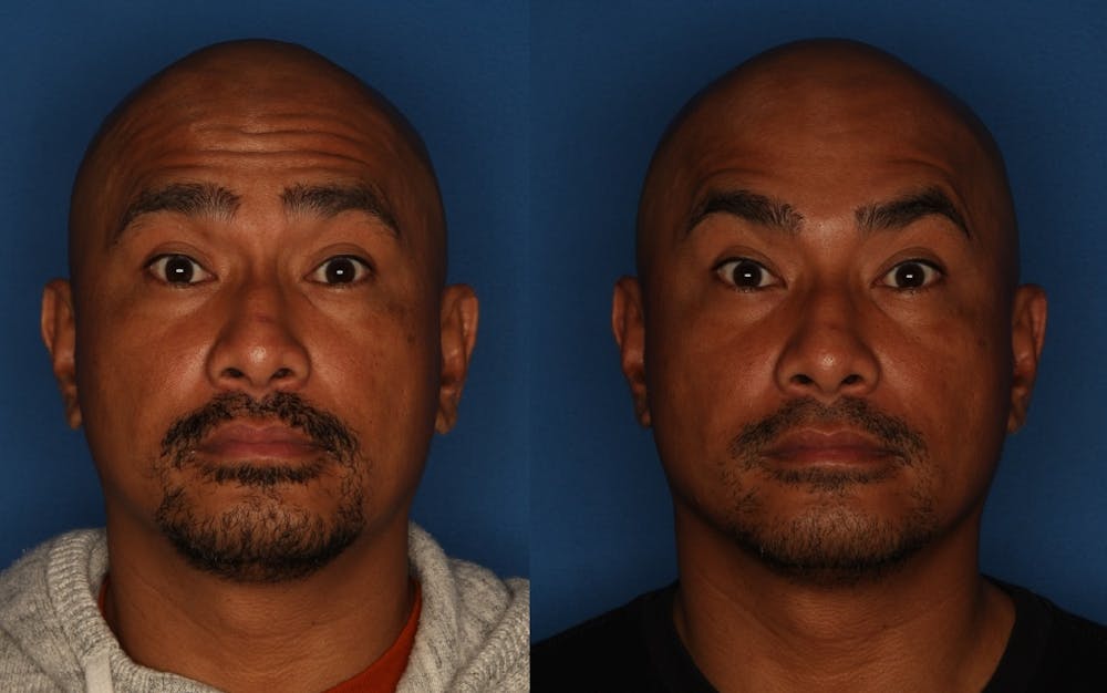 BOTOX Before & After Gallery - Patient 142944786 - Image 2